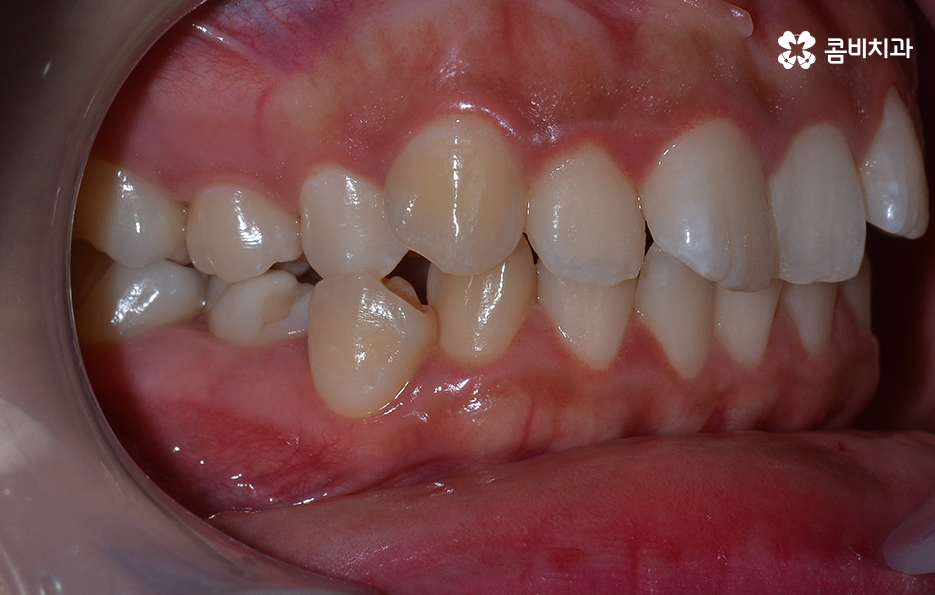 덧니 발치 교정 이런 경우에는 필요합니다 관련 이미지 4