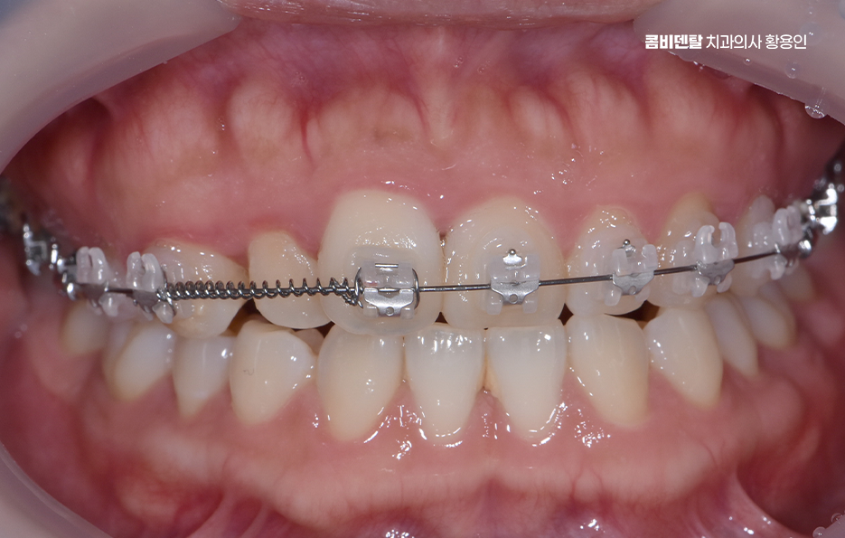 치아교정 통증 줄이는 방법 어떻게 가능할까요 관련 이미지 6