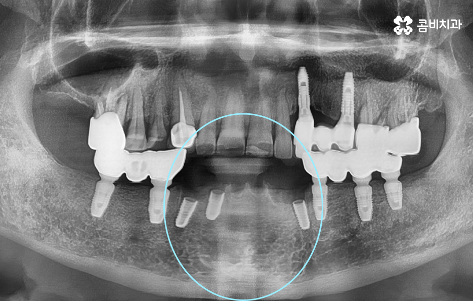 발치후 임플란트 기간 현실적으로 알아보면 관련 이미지 2