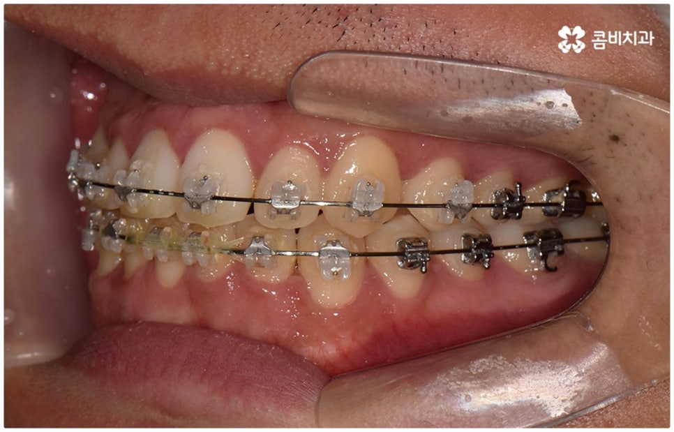 부정교합 3급 왜 고쳐야 하나요 관련 이미지 12
