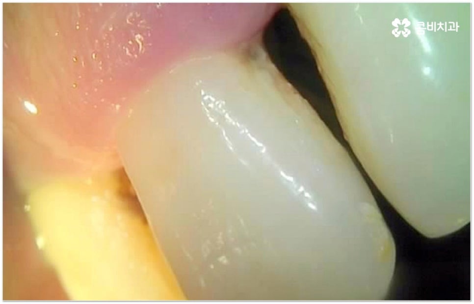 뼈이식임플란트 언제하나요? 관련 이미지 2