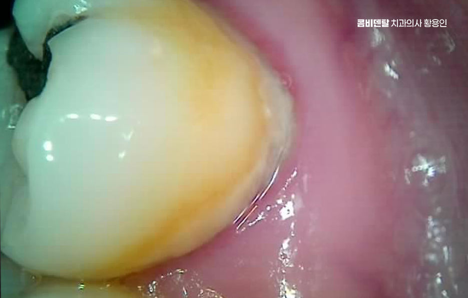 인레이 치료 후 신경치료 이유가 궁금하다면 관련 이미지 5