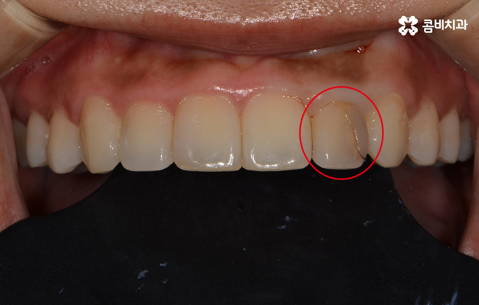 앞니 충치치료 개인에 따라 달라지는 이유 관련 이미지 1