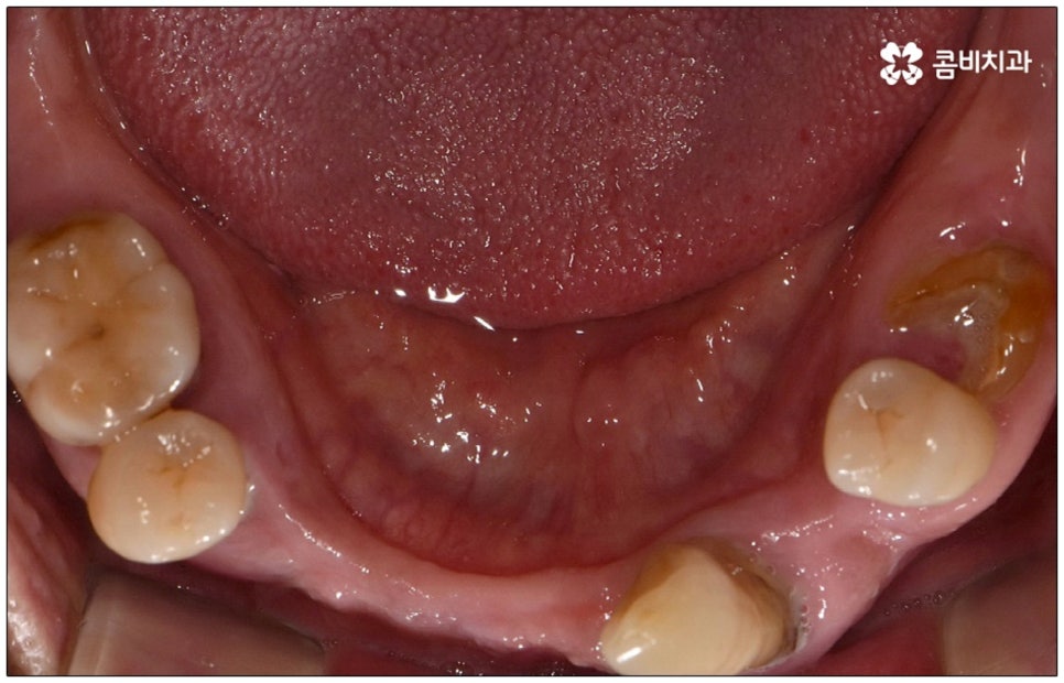 노인임플란트 참고사항 알아봐요 관련 이미지 6