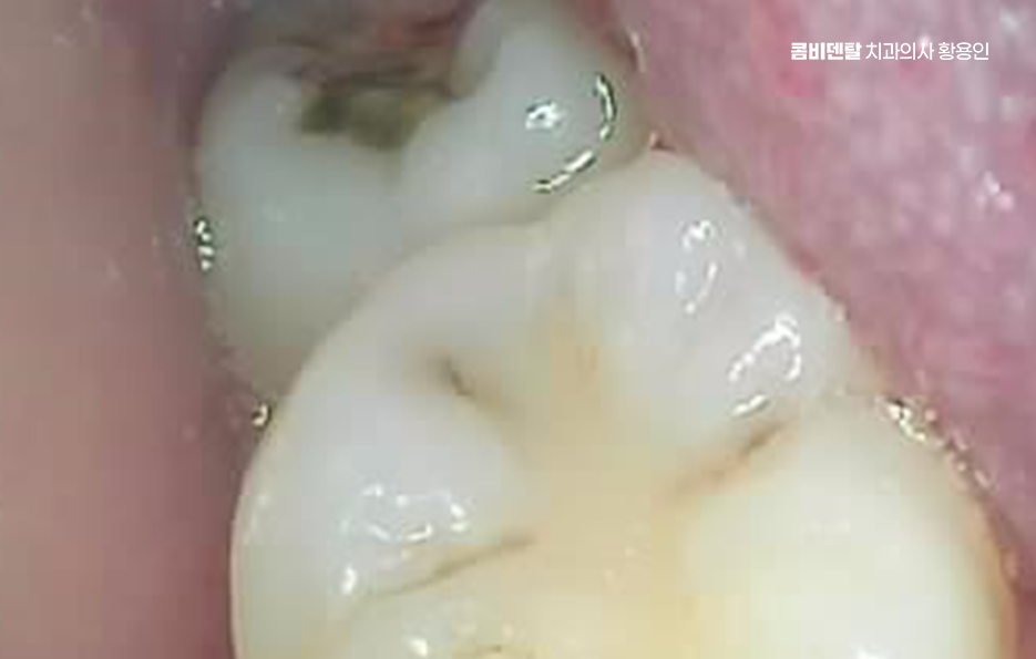 명동치과 흔하게 놓치는 사례를 정리해요 관련 이미지 7
