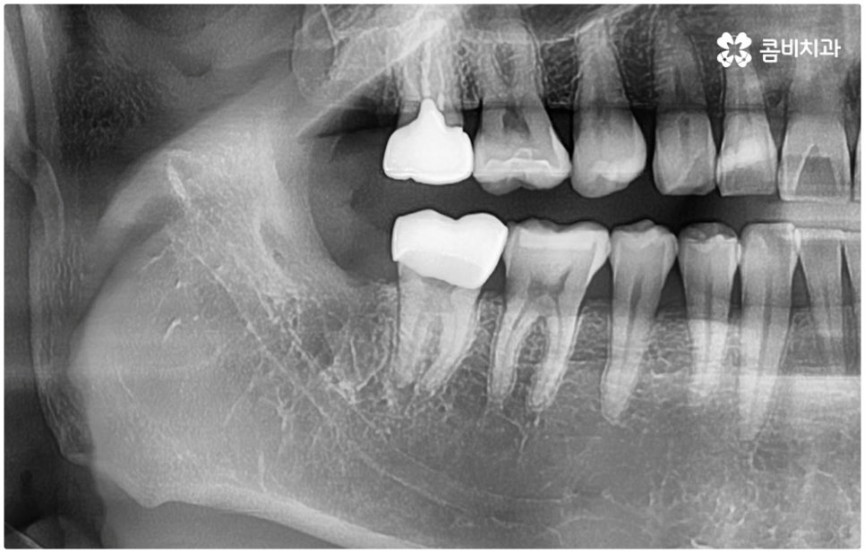 매복사랑니발치치과 어디로 가나요? 관련 이미지 4