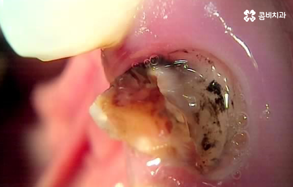 충치 단계 어떻게 분류하고 치료해야 하나요 관련 이미지 3