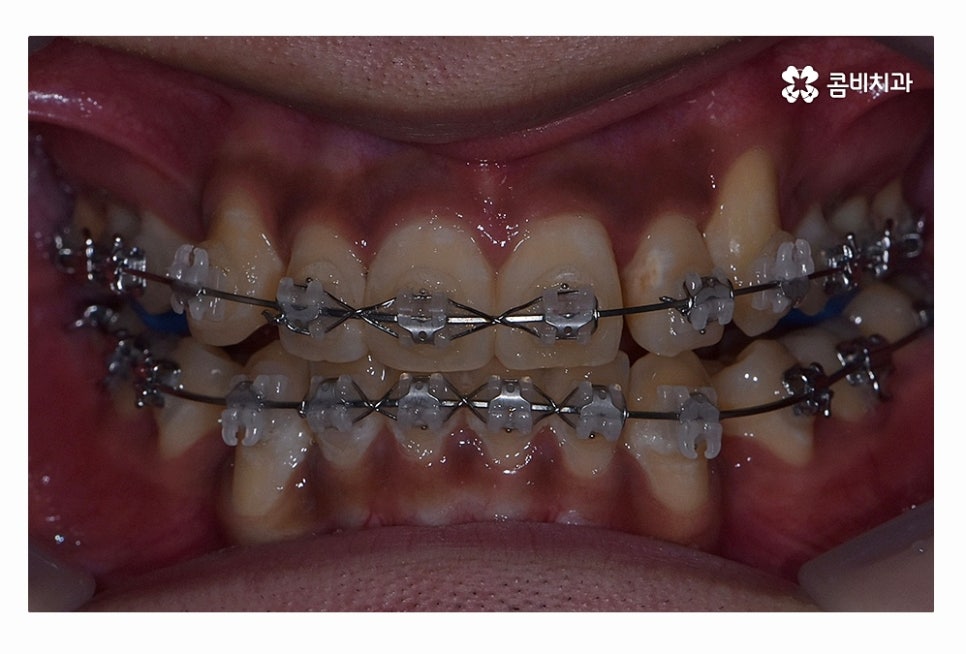 덧니 발치 필수적으로 하는건가요 관련 이미지 12