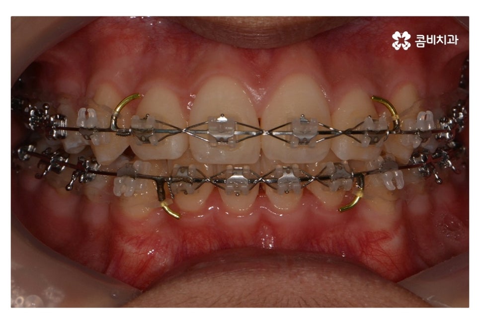 중학생치아교정 세심하게 체크하려면 관련 이미지 11
