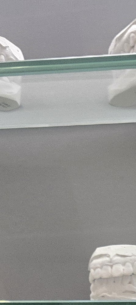 앞이빨 임플란트 과정 주의해야할 포인트는 관련 이미지 13