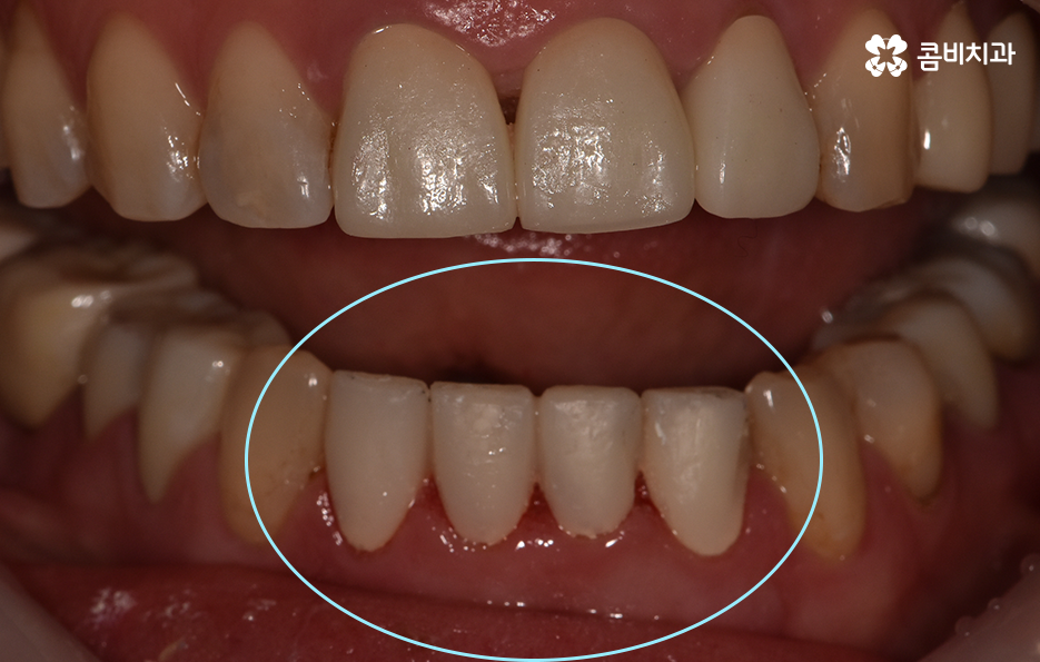 아래 앞니깨짐 치료 감쪽같이 해결하려면 관련 이미지 5