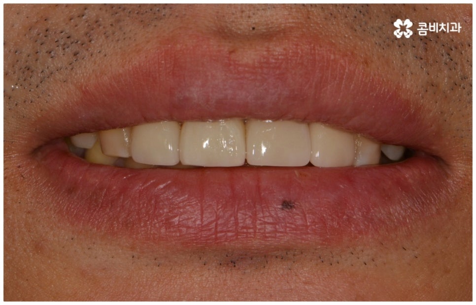 앞니충치치료 어떻게 이뤄지나요 관련 이미지 13
