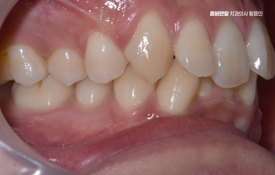 Can Crooked Lower Teeth Be Improved Without Extraction? image 3