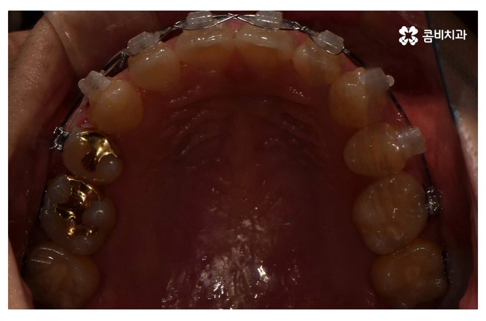 덧니교정 정확하게 알아보려면 관련 이미지 13