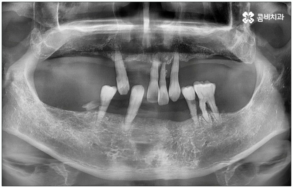 노인임플란트 참고사항 알아봐요 관련 이미지 1