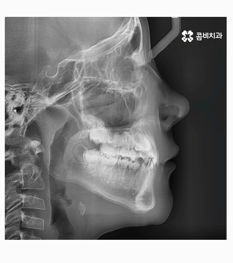 과개교합교정 어릴때 고쳐주면 좋은 사례 관련 이미지 6