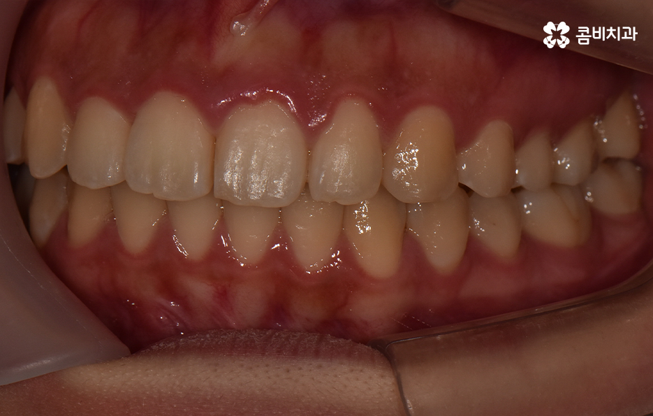 덧니 발치 교정 이런 경우에는 필요합니다 관련 이미지 14