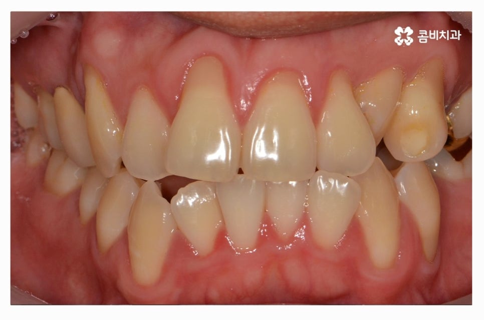 클리피씨교정 올바르게 판단하려면 관련 이미지 1