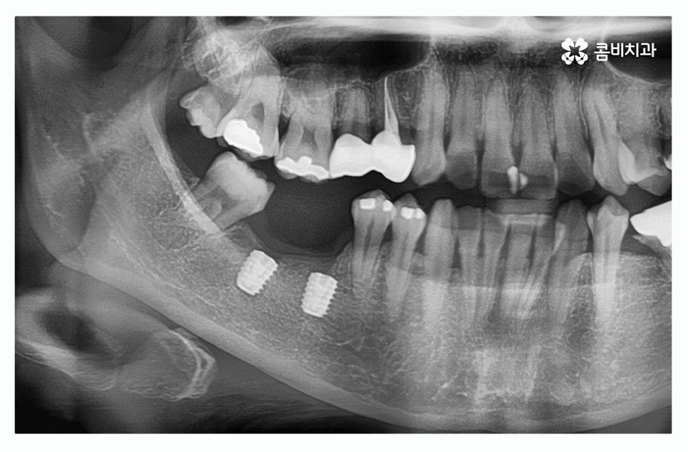 임플란트종류 잘알아보고 적용하려면 관련 이미지 3