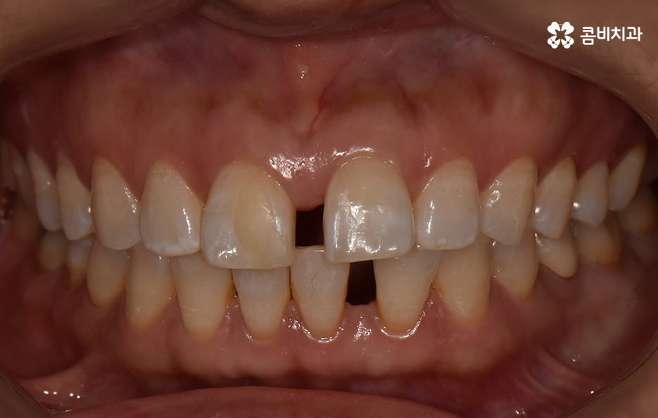 중년치아교정 이제라도 해도 될까요 관련 이미지 1