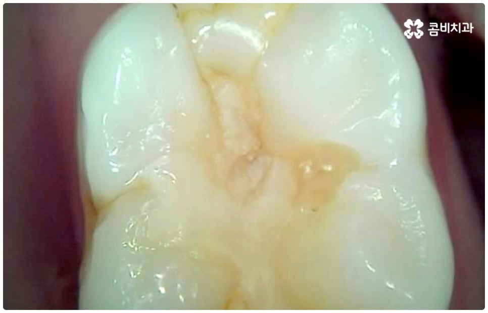 충치치료종류 알아볼까요? 관련 이미지 6
