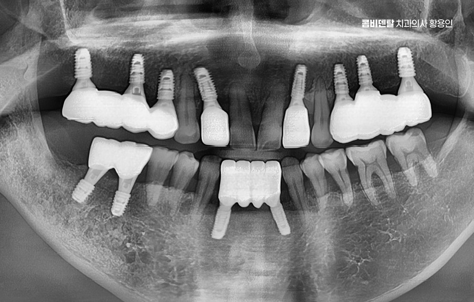 50대임플란트 꼼꼼하게 따져봐야할 포인트는 관련 이미지 10