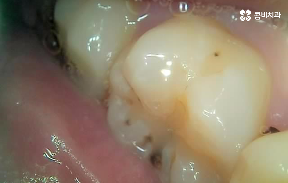 어금니 레진 깨짐 변색 안아파도 이렇게 대처하세요 관련 이미지 4