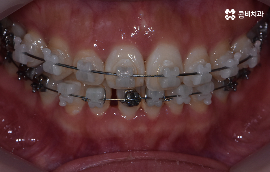 비발치치아교정 고민되는데 발치하면 안좋나요 관련 이미지 9