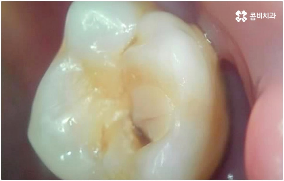 발치후 임플란트 바로 되나요? 관련 이미지 3