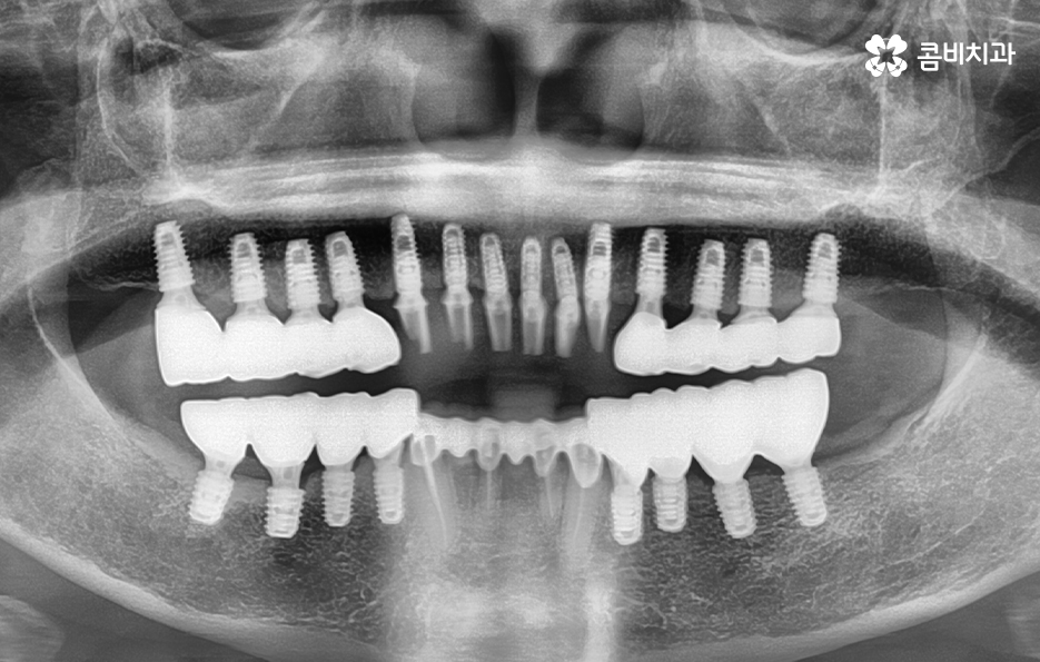 65세이상임플란트 고령이기에 간과하지 말아야 할 사항은 관련 이미지 7
