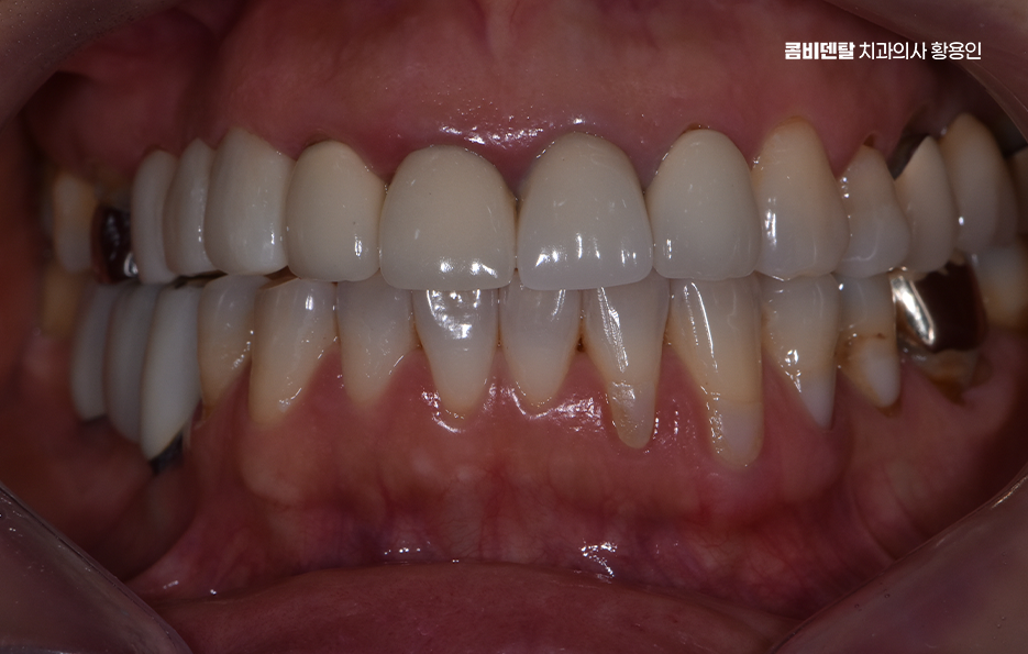 앞니 크라운 교체 깔끔하게 정리하려면 관련 이미지 6