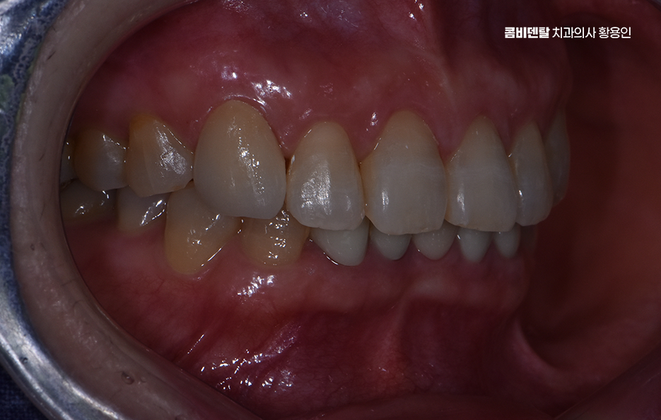 송곳니 크라운 티가 안나게 해결 가능한건가요 관련 이미지 8