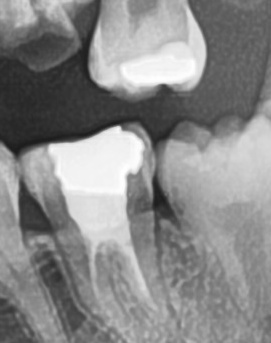 어금니 뒤 잇몸 부음 어떤 문제길래 이런거죠 관련 이미지 35