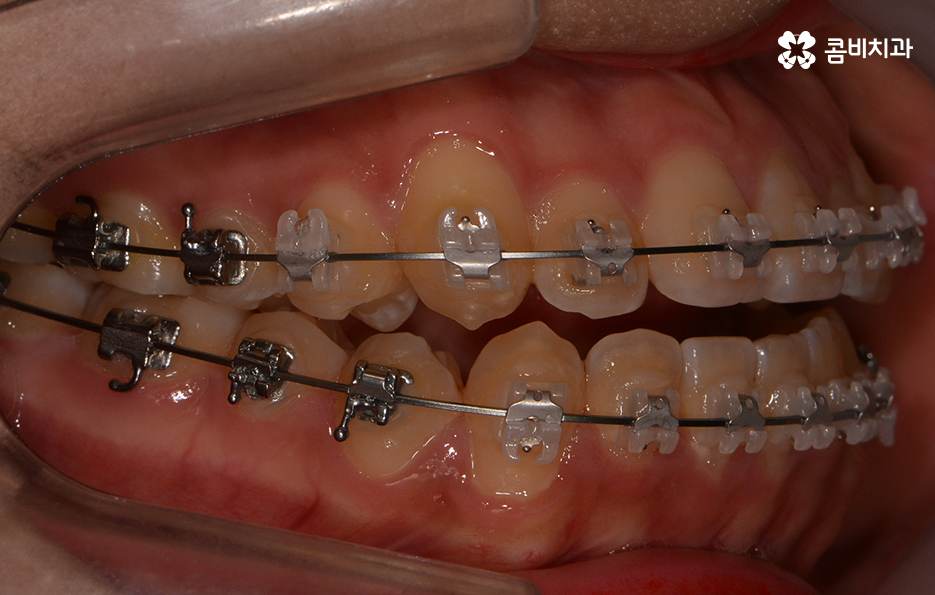 송곳니 덧니 뽑지 않고 해결된 사례 관련 이미지 12