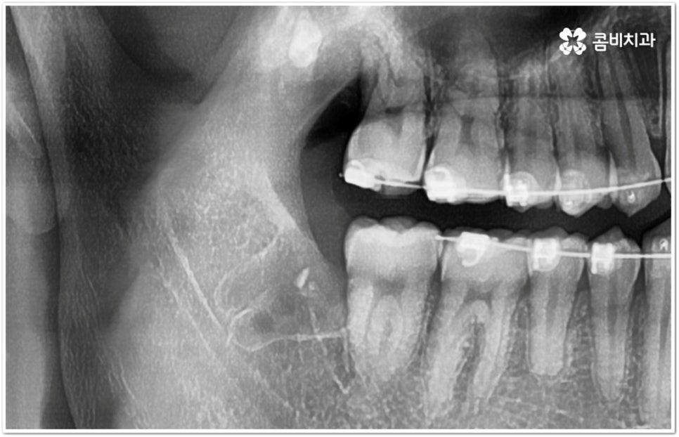 아래사랑니발치 망설이고 있다면 관련 이미지 6