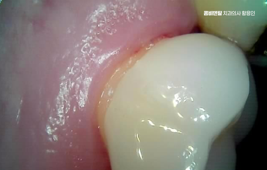인레이 치료 후 통증 자꾸 심해지는데 괜찮은걸까 관련 이미지 10
