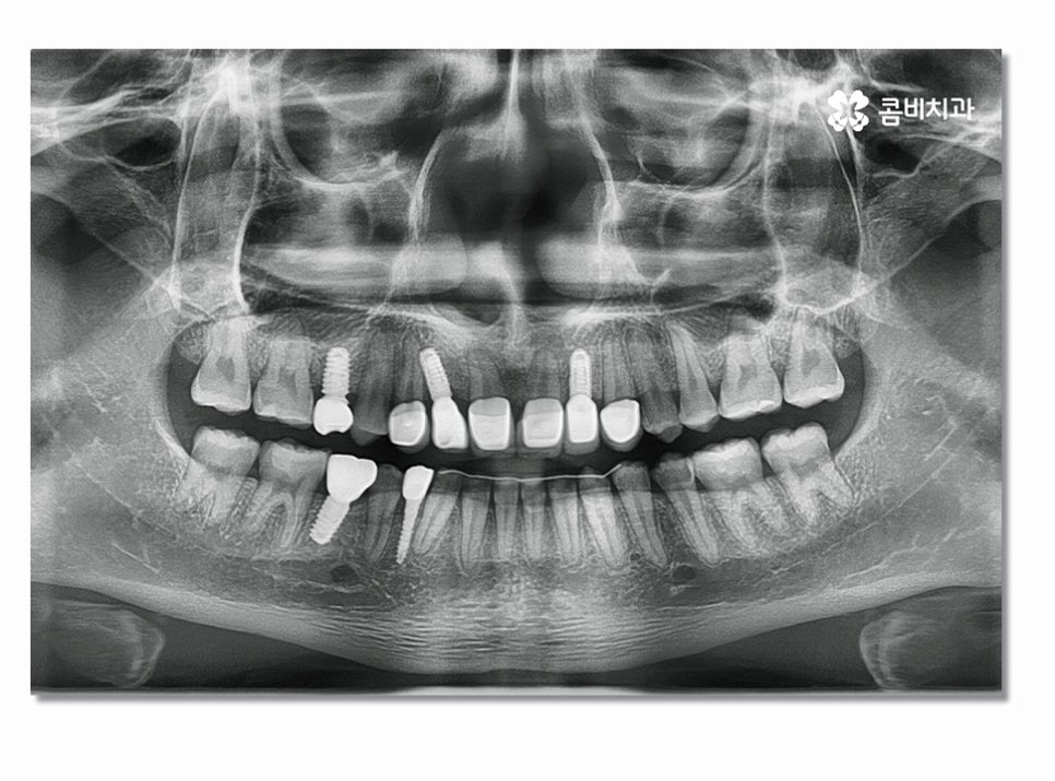 앞니임플란트 합리적으로 접근하려면 관련 이미지 7