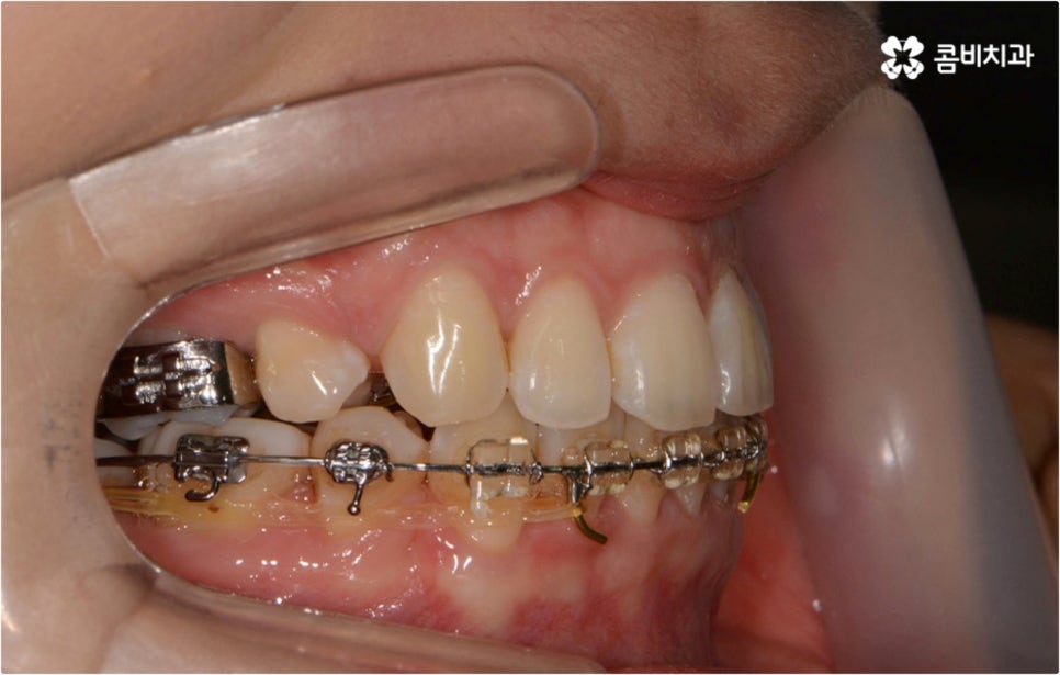 돌출입 치아교정 부모와 아이가 함께 알아봐요 관련 이미지 9