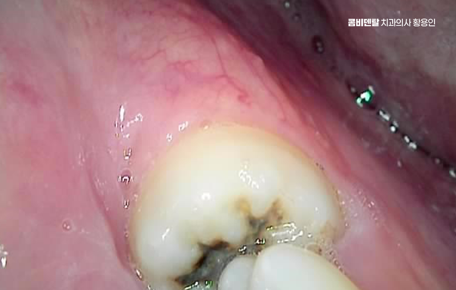 How to Systematically Prepare for Wisdom Tooth Extraction Due to Cavities image 4