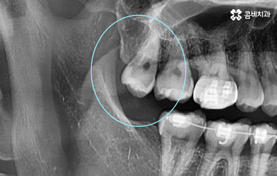 사랑니 발치 시기 이럴때 시작하면 좋아요 관련 이미지 2