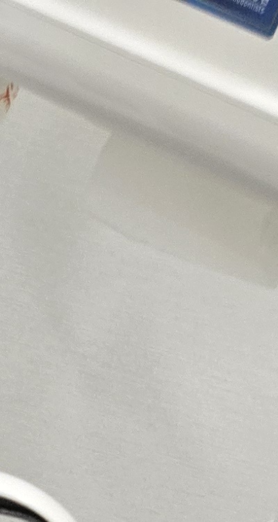 치아 사이 벌어짐 심해지는 이유부터 알아보면 관련 이미지 16