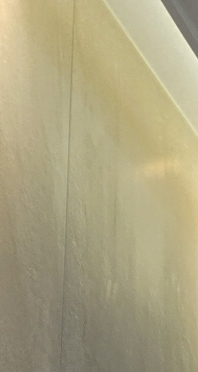 앞니 신경치료 크라운 까지 해야할 상황이라면 관련 이미지 17