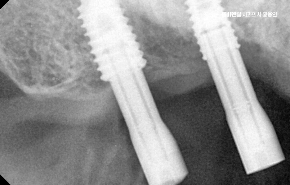 어금니 없으면 얼굴 발음에 어느정도나 안좋을까 관련 이미지 11