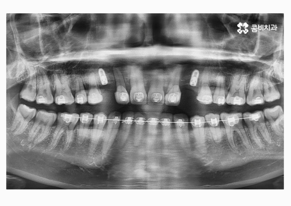 30대임플란트 향후 미래를 바라본다면 관련 이미지 9
