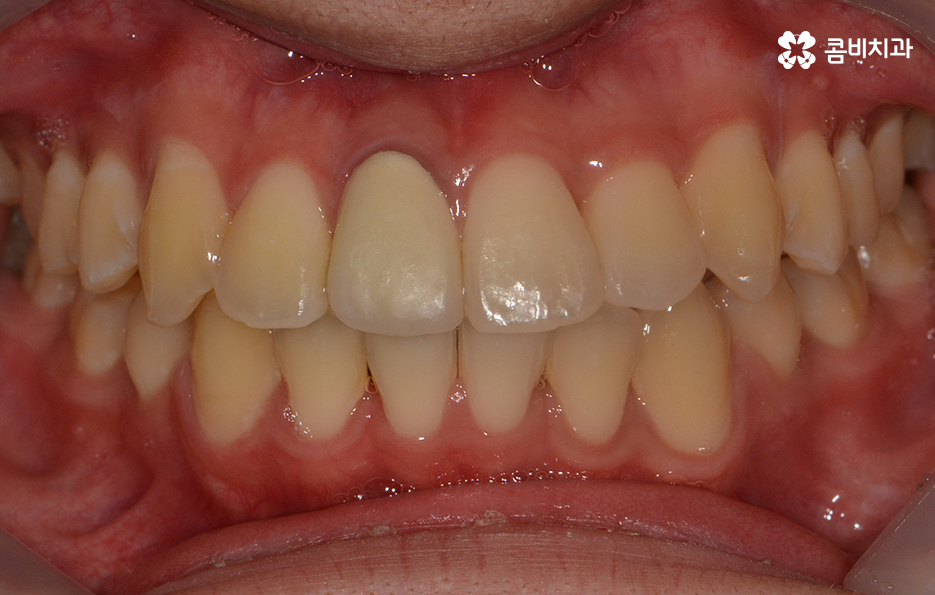 덧니교정 불편함이 느껴지지 않더라도 관련 이미지 12