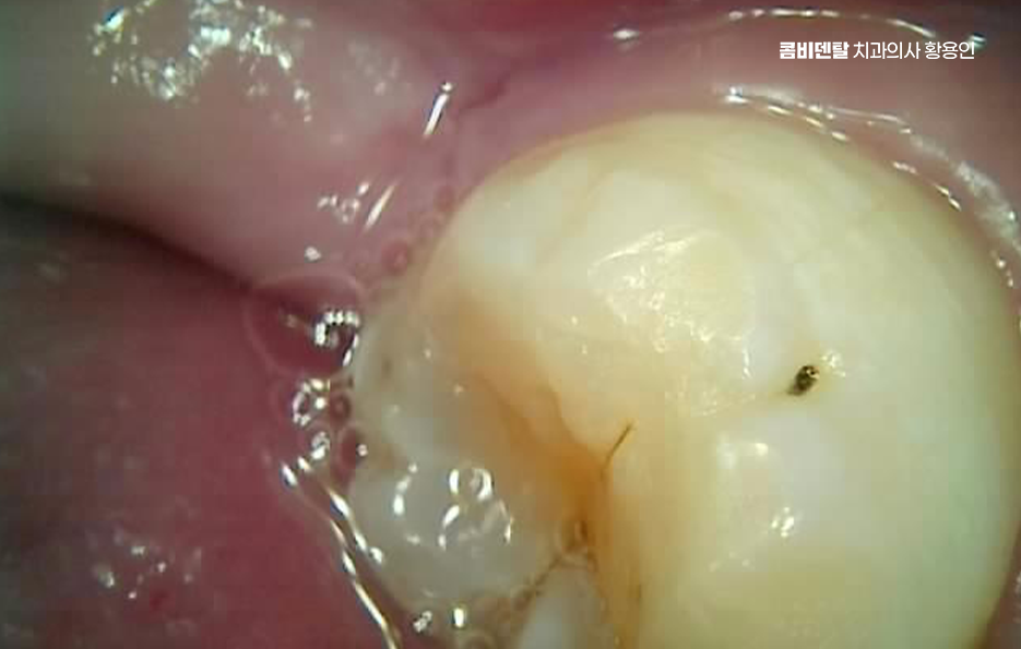 충치 검은점 나타났다면 이렇게 대처해요 관련 이미지 7