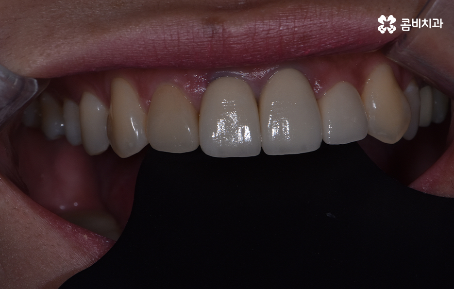 치아 깨짐 다시 튼튼하게 수복하기 위한 방법 관련 이미지 11