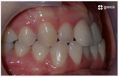 치아교정장치 어떻게 고르나요 관련 이미지 4