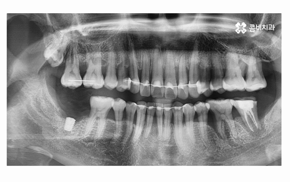 어금니 발치 심각해지기 전에 막으려면 관련 이미지 10