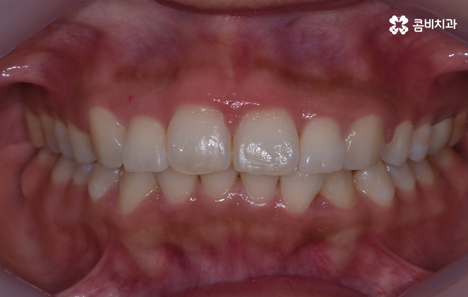 앞니 틀어짐 교정 방법 이럴때는 좀더 간단해요 관련 이미지 6
